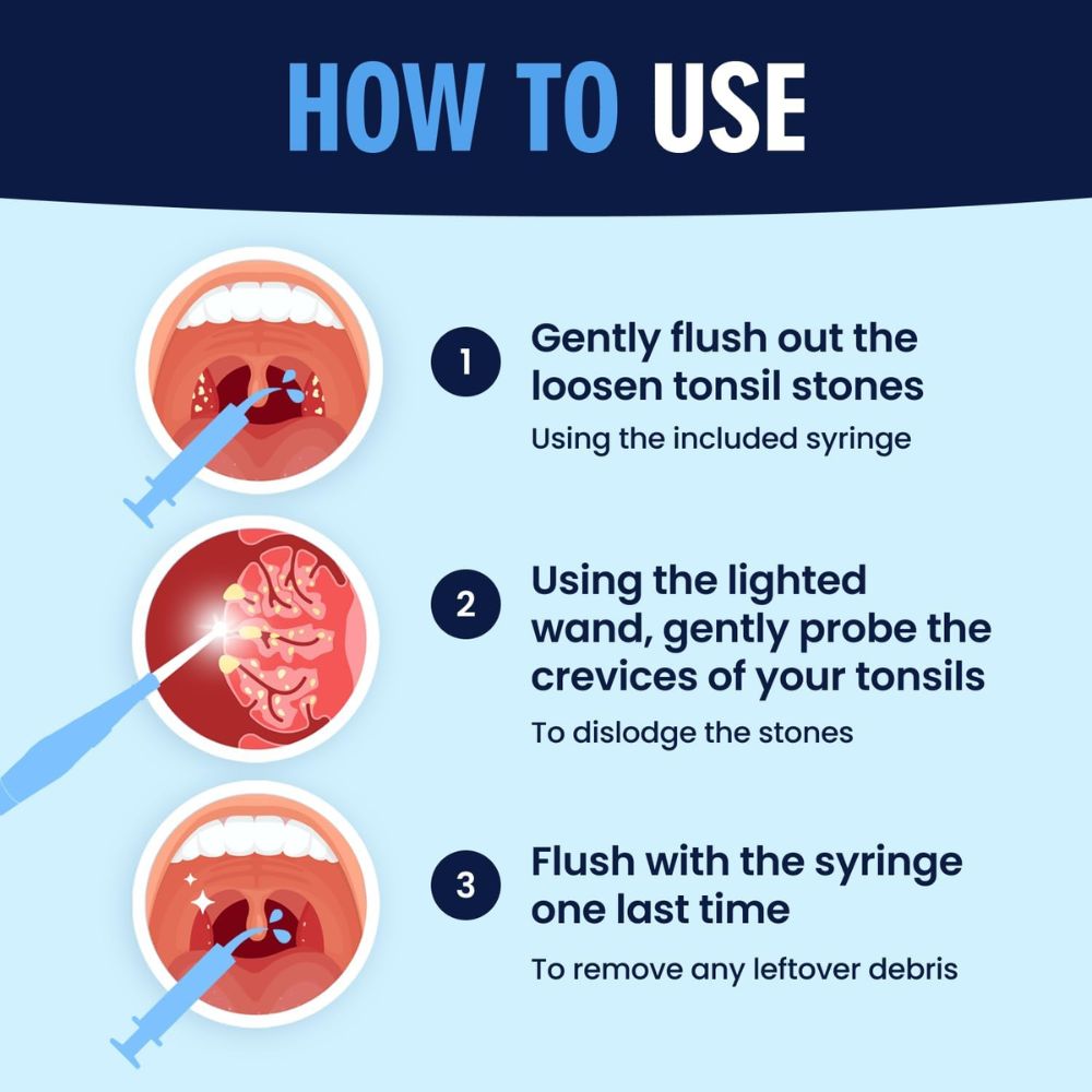 Dr. Frederick's Tonsil Stone Remover Kit
